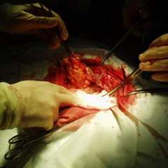 Оперативное лечение кисты урахуса, фото